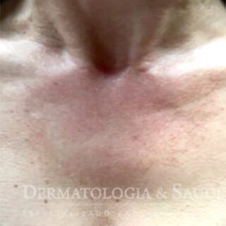 Poiquilodermia de civatte