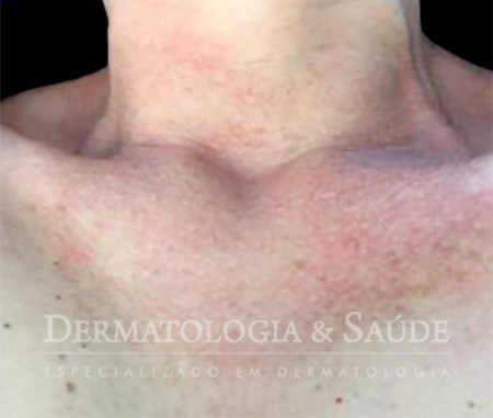 Poiquilodermia de Civatte.