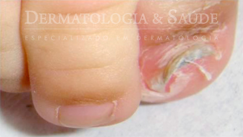 Unha encravada bebê