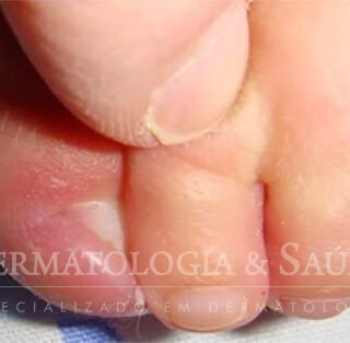 Unha encravada bebê