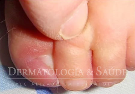 Unha encravada bebê