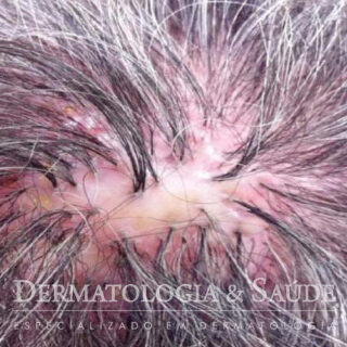 Espinhas no couro cabeludo