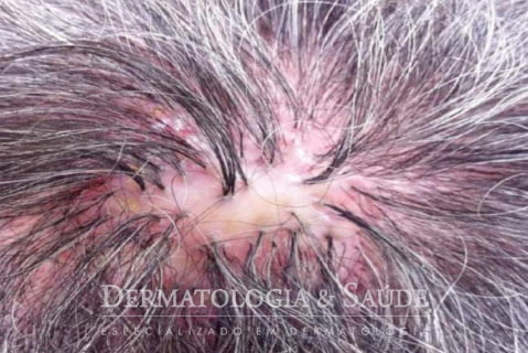 Espinhas no couro cabeludo