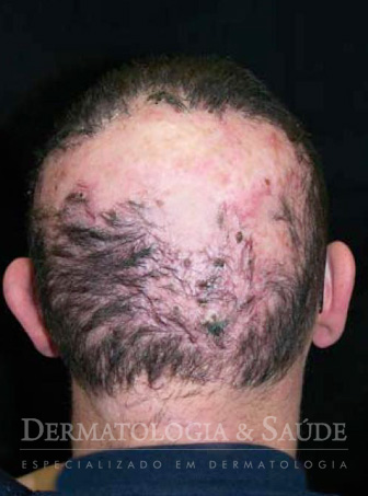 Espinhas no couro cabeludo