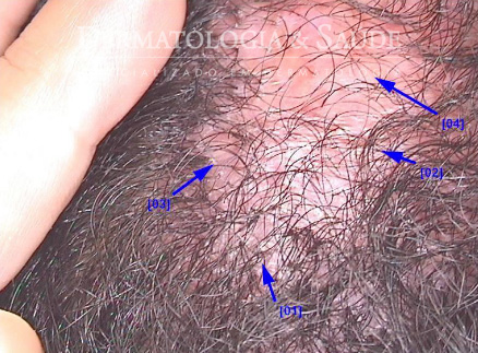 Espinhas no couro cabeludo