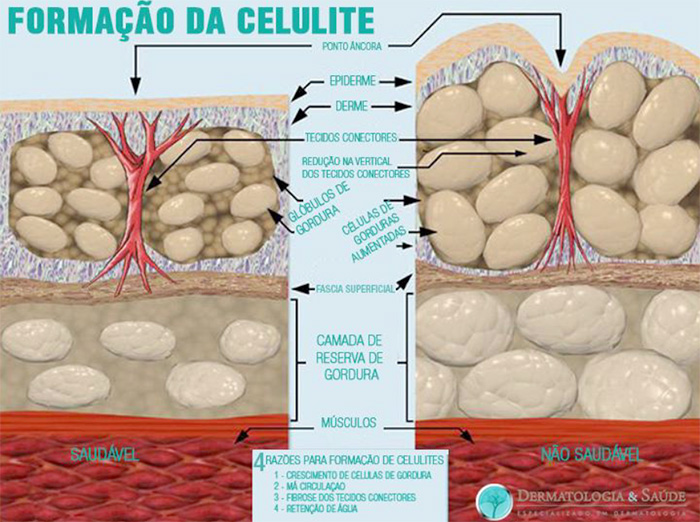 Formação da celulite