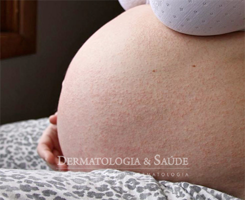 Manchas na gravidez