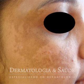 Melasma na gestação