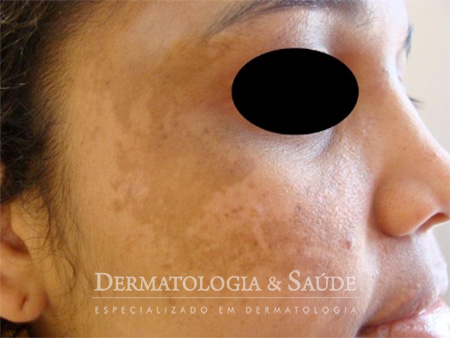Melasma na gestação