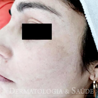 Melasma