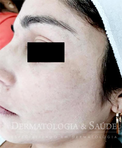 Melasma