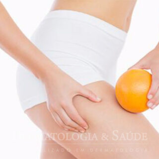 Mitos e verdades sobre a Celulite