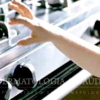 Queimadura em criança