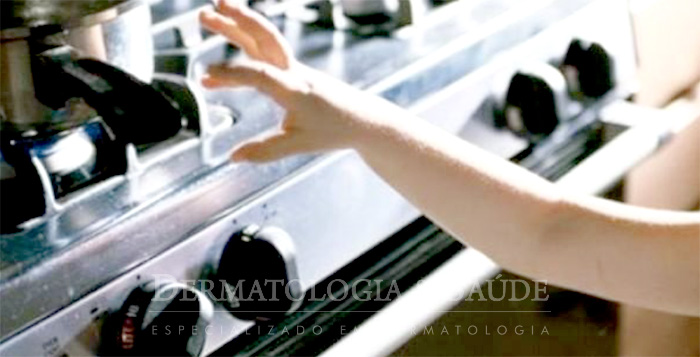 Queimadura em criança