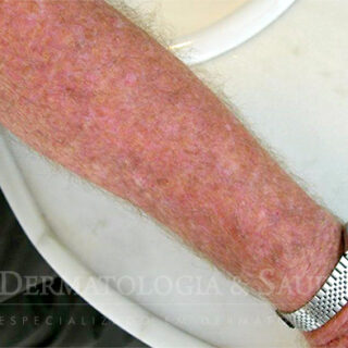 Terapia Fotodinâmica