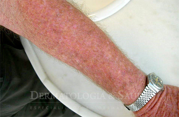 Terapia Fotodinâmica