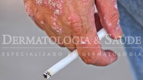 Psoríase e fumo