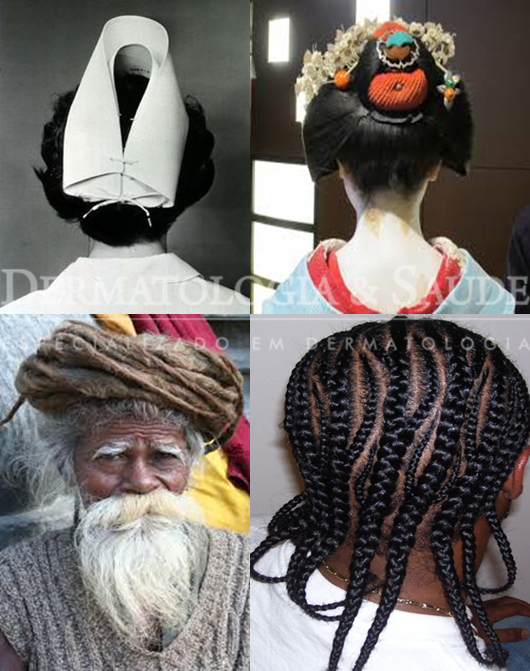 Alopécia de tração