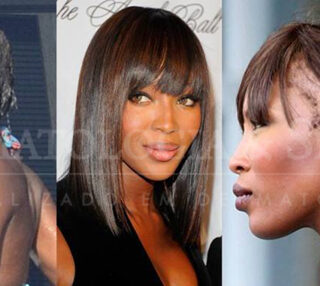 Naomi Campbell com uma extensa área de alopecia frontal aparente