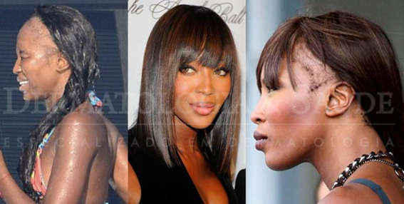 Naomi Campbell com uma extensa área de alopecia frontal aparente