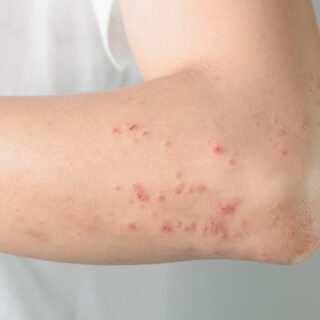 Dermatite Herpetiforme