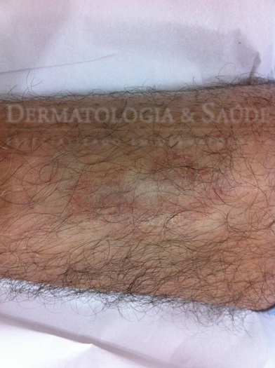 Dermopatia diabética 