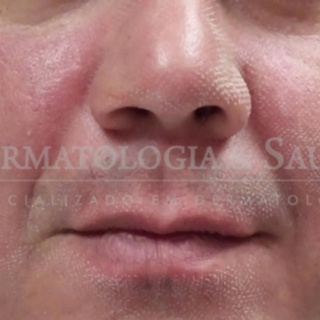 Laser de CO2 fracionado