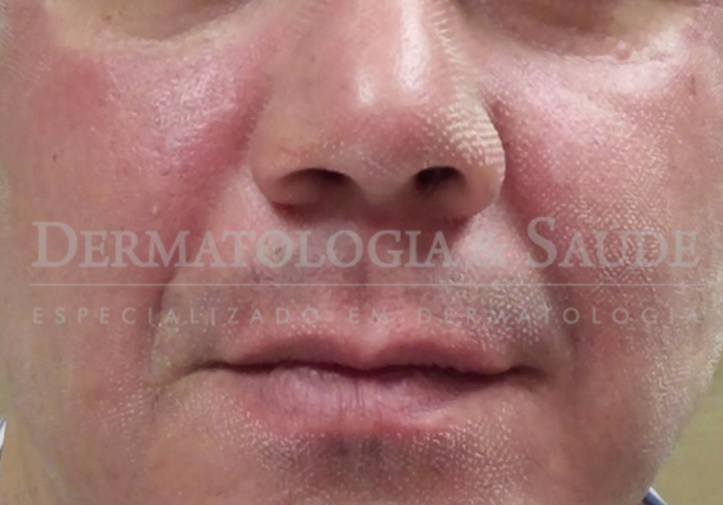 Laser de CO2 fracionado