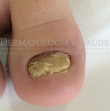 Micose - Tenho diabetes...e agora?