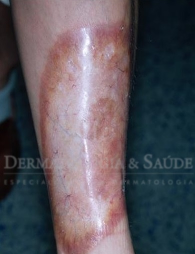 Necrobiose lipoídica 