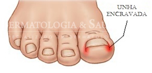 Unha Encravada