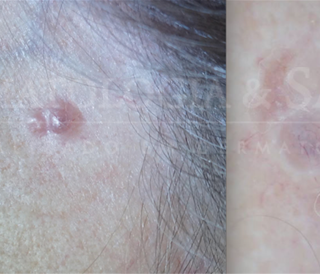 Câncer de pele coça ou dói?