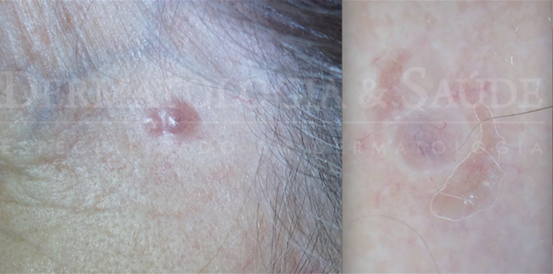 Câncer de pele coça ou dói?