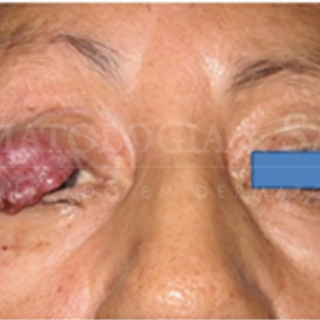 O Carcinoma de Células de Merkel acomete principalmente as áreas de pele expostas ao sol.