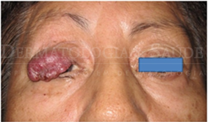 O Carcinoma de Células de Merkel acomete principalmente as áreas de pele expostas ao sol.