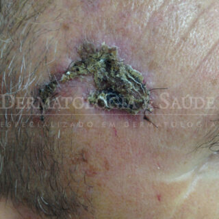 Cascão em cicatriz de cirurgia