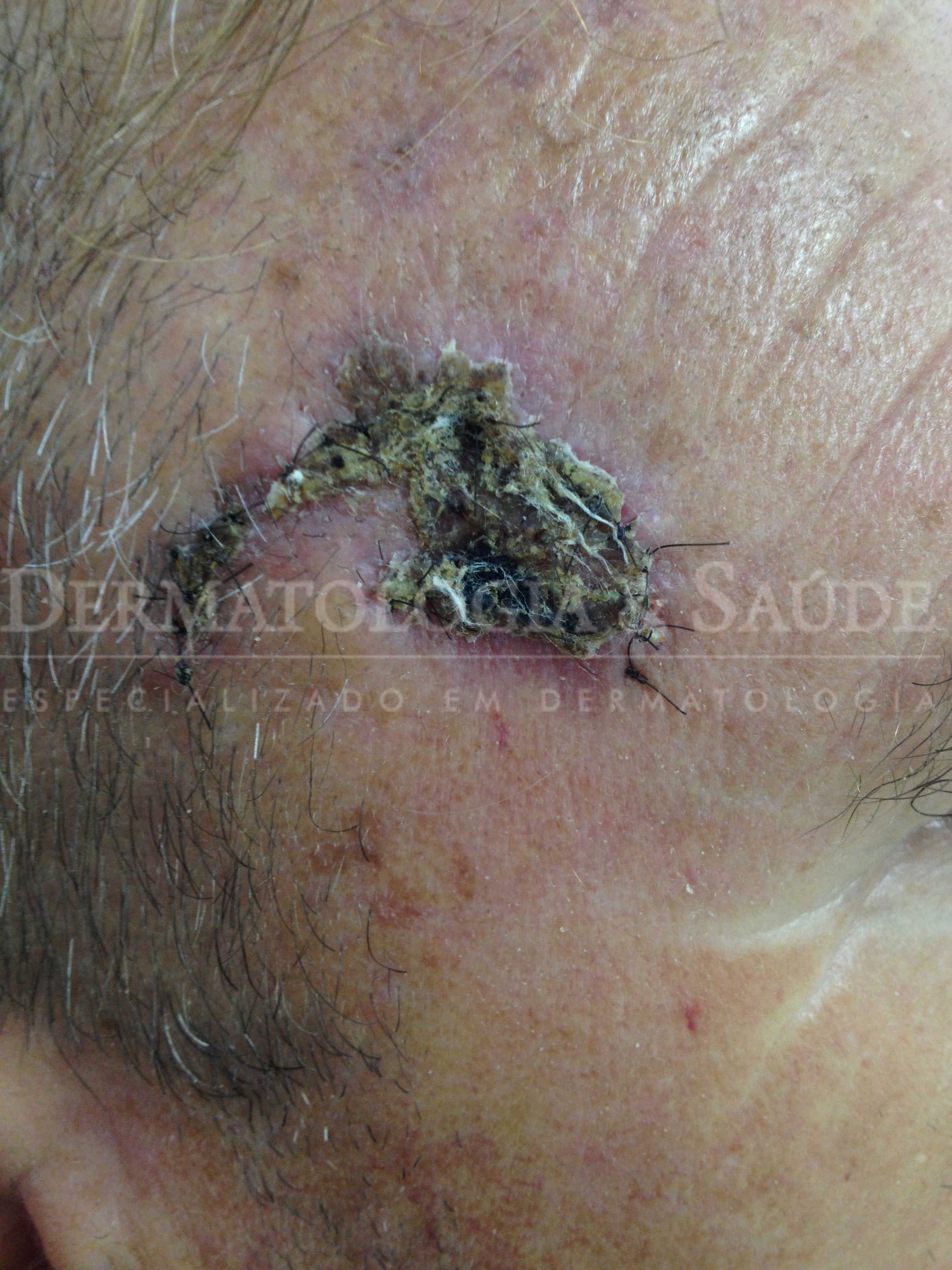 Cascão em cicatriz de cirurgia