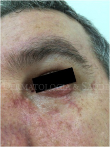 Cicatriz em pálpebra inferior 