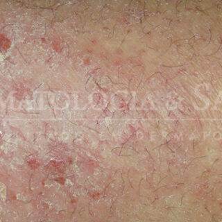 Dermatite atópica e fototerapia UVB narrow band