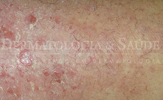 Dermatite atópica e fototerapia UVB narrow band