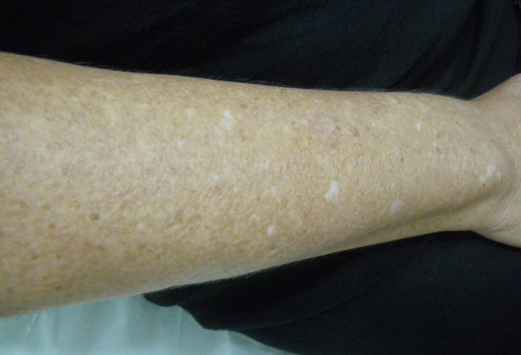 leucodermias-gutatas