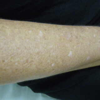 leucodermias-gutatas