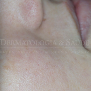 Cicatrizes pouco visíveis