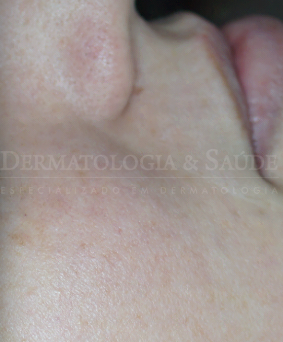 Cicatrizes pouco visíveis