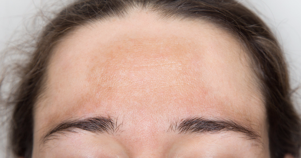 Melasma