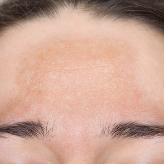 Melasma