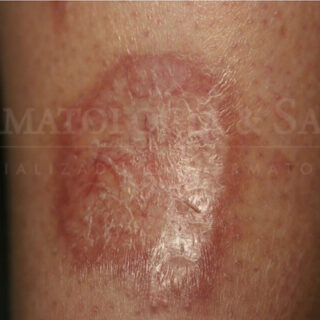 Necrobiose lipoídica