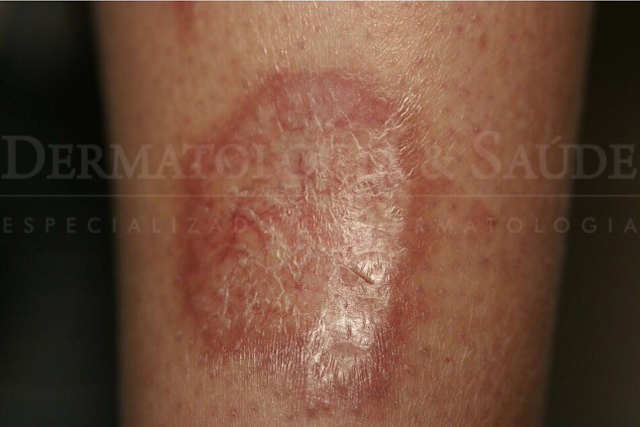 Necrobiose lipoídica