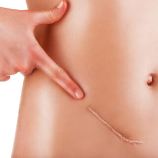 Como cuidar das feridas e prevenir queloides ou manchas