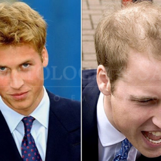 A calvície do Príncipe